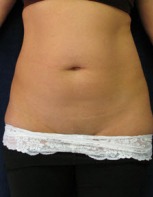 Liposuction