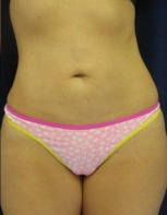Liposuction Case 2828 After Photo Liposuction
