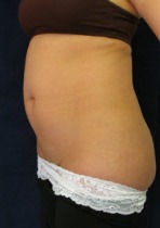 Liposuction Case 2828 Before Photo Liposuction
