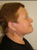 Face, Brow & Neck Lifts