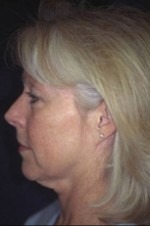 Face, Brow & Neck Lifts