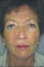 Face, Brow & Neck Lifts