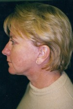 Face, Brow & Neck Lifts