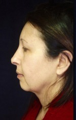 Face, Brow & Neck Lifts