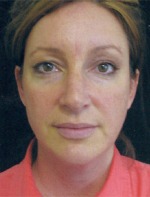 Face, Brow & Neck Lifts