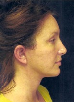 Face, Brow & Neck Lifts Case 2871 After Photo Face, Brow & Neck Lifts