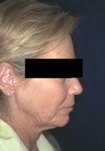 Face, Brow & Neck Lifts