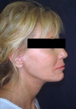 Face, Brow & Neck Lifts