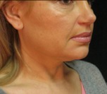 Face, Brow & Neck Lifts