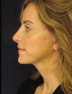 Face, Brow & Neck Lifts