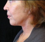 Face, Brow & Neck Lifts