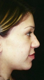 Nose Reshaping