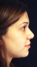 Nose Reshaping