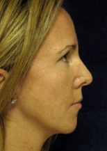 Nose Reshaping Case 2921 After Photo Nose Reshaping