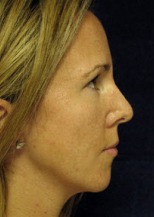 Nose Reshaping