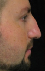 Nose Reshaping