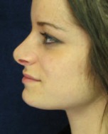 Nose Reshaping Case 2936 After Photo Nose Reshaping