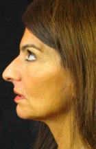 Nose Reshaping Case 2939 Before Photo Nose Reshaping