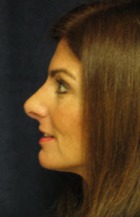 Nose Reshaping Case 2939 After Photo Nose Reshaping