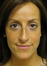 Nose Reshaping Case 2942 Before Photo Nose Reshaping