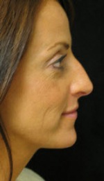 Nose Reshaping Case 2942 Before Photo Nose Reshaping