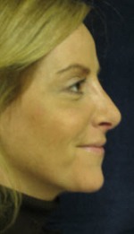 Nose Reshaping Case 2942 After Photo Nose Reshaping