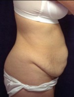 Tummy Tuck