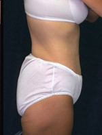 Tummy Tuck