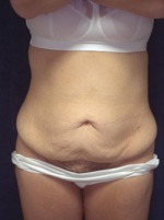 Tummy Tuck