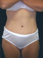 Tummy Tuck