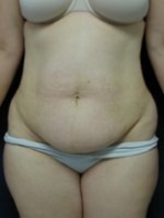 Tummy Tuck