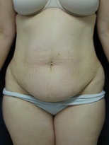 Tummy Tuck Case 2952 Before Photo Tummy Tuck