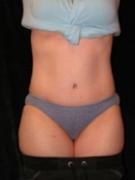 Tummy Tuck