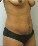 Tummy Tuck