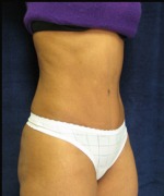 Tummy Tuck