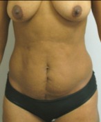 Tummy Tuck