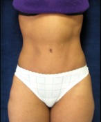 Tummy Tuck