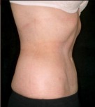 Tummy Tuck