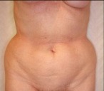 Tummy Tuck