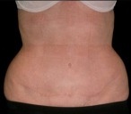 Tummy Tuck