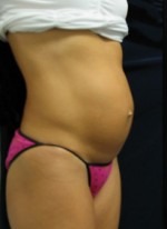 Tummy Tuck