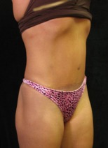 Tummy Tuck