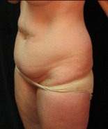 Tummy Tuck Case 2970 Before Photo Tummy Tuck