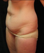 Tummy Tuck