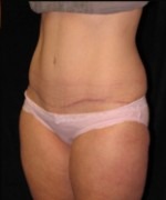 Tummy Tuck