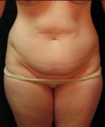 Tummy Tuck