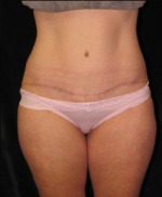 Tummy Tuck