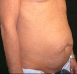 Tummy Tuck