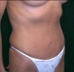 Tummy Tuck