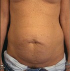 Tummy Tuck